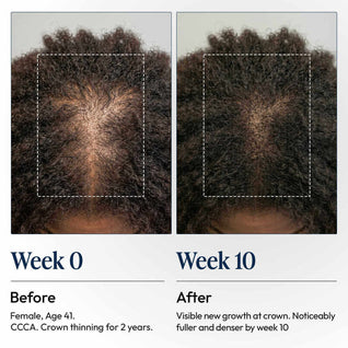 DermDe Hair Regrowth Treatment Kit
