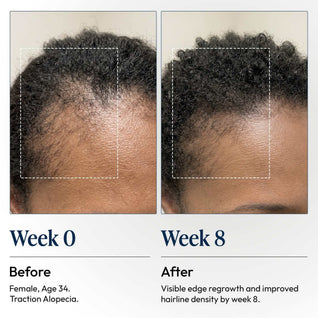 DermDe Hair Regrowth Treatment Kit