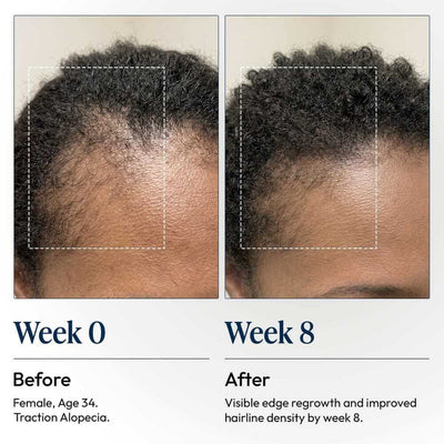 DermDe Hair Regrowth Treatment Kit