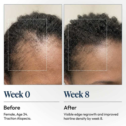 DermDe Hair Regrowth Treatment Kit