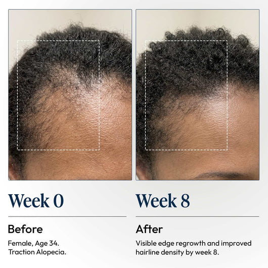 DermDe Hair Regrowth Treatment Kit